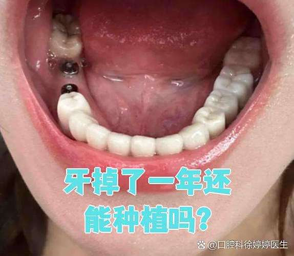 杭州牙齿掉了还能种吗？现在种牙靠谱不靠谱