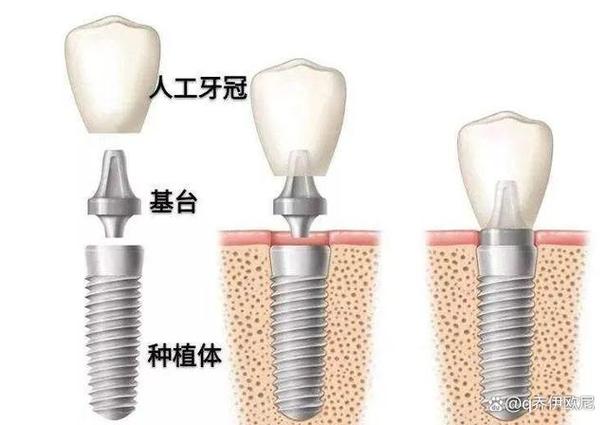 杭州集采种牙和自费种牙到底差在哪