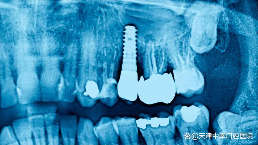 杭州深圳罗湖骨量不足全口种牙到底要花多少钱