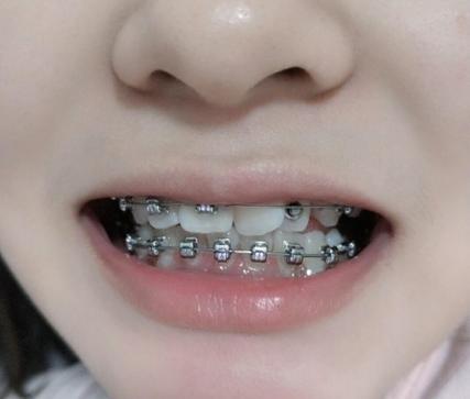 杭州30岁做牙齿矫正有什么后遗症？看完这篇不踩坑