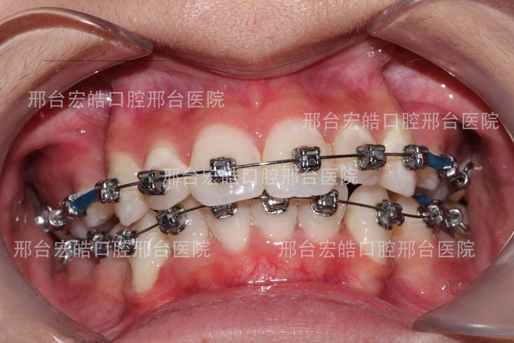 杭州不整齐牙齿矫正到底要花多少钱？大概多久能好？
