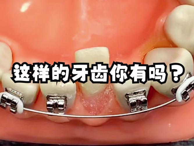 杭州8岁小孩牙齿歪了能矫正吗 家长别错过最佳时机