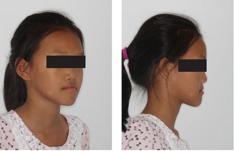 杭州深圳儿童地包天几岁矫正最好