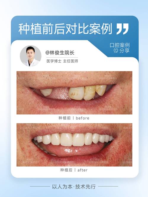 杭州深圳坪山种一颗牙多少钱 价格明细来了