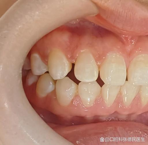 杭州深圳牙缝过大矫正报价大概多少钱?
