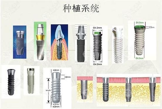 杭州种植牙国产韩系欧美价格对比，哪个品牌性价比高？