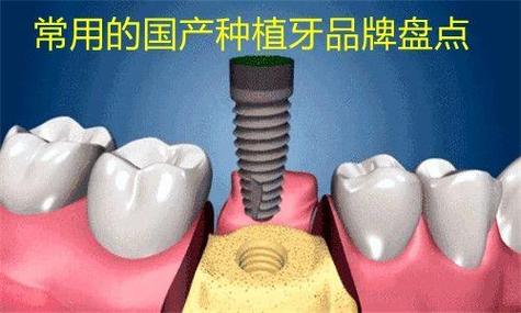 杭州潍坊国产种植牙百康特多少钱一颗？
