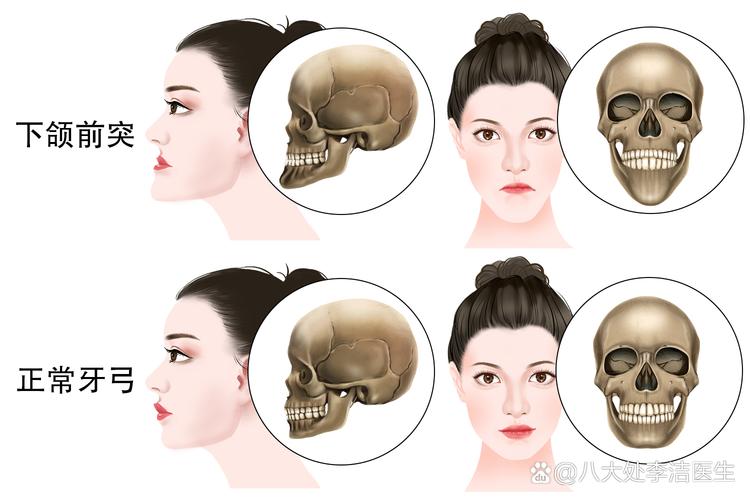 儿童地包天矫正可以用医保吗_儿童地包天矫正器多少钱_深圳儿童地包天矫正多少钱