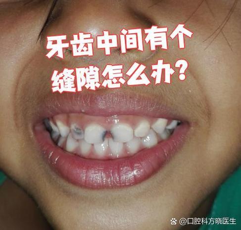 杭州门牙有缝怎么矫正？这几种方法亲测有效