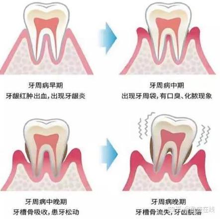 杭州三十岁还能整牙吗？成人牙齿矫正必知真相