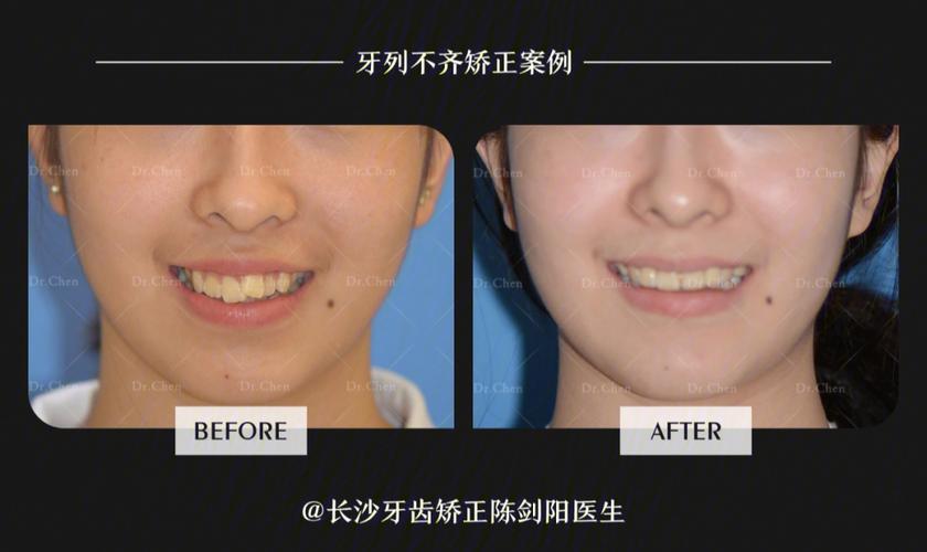 杭州拔门牙矫正牙齿会松动吗？正畸医生说出大实话