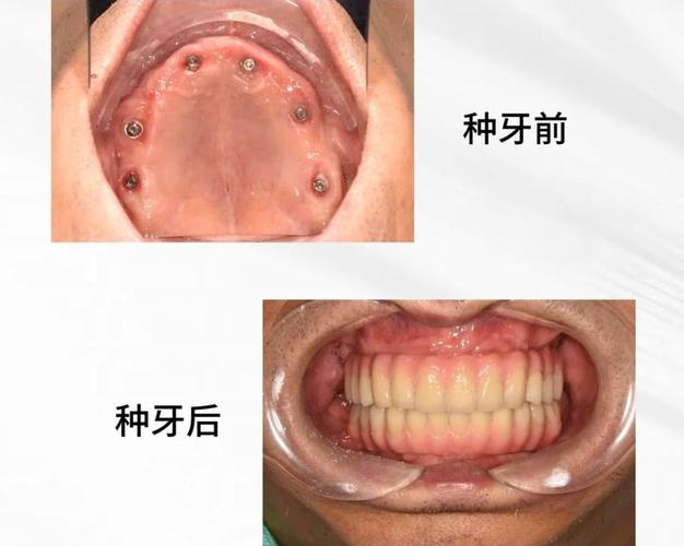 深圳种牙有补贴吗_深圳种植牙补贴规定_深圳种植牙失败了怎么补救