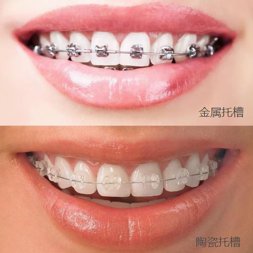 杭州深圳深覆合矫正价格大揭秘