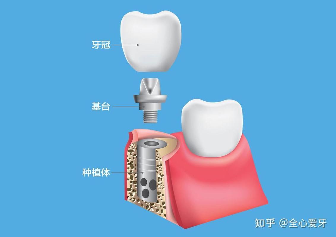 深圳牙福口腔门诊怎么样_深圳福田全口即刻种牙收费_深圳福田牙科医院哪家好