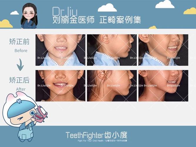 牙齿矫正一般多大年龄合适_牙齿矫正最好的年龄阶段是多少_矫正牙齿更佳年龄