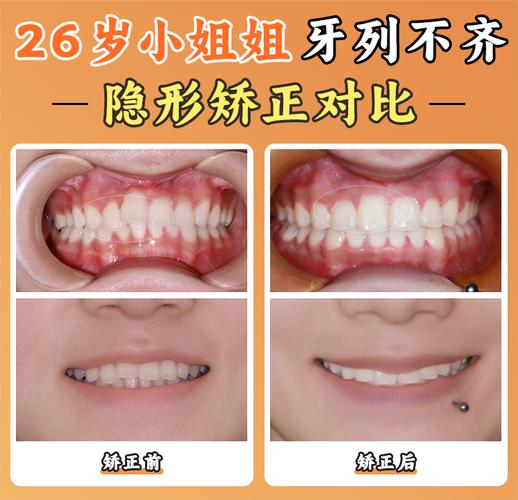 杭州北京舌侧矫正靠谱吗？价格/医院/医生全揭秘