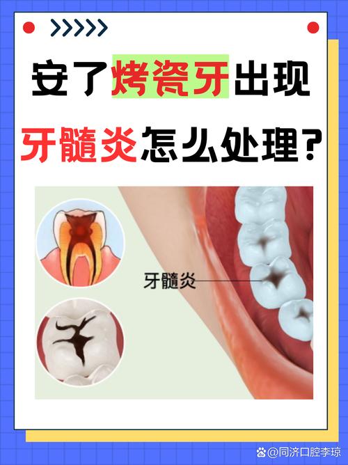 杭州牙医良心忠告：做烤瓷牙前这两点不注意，当心毁了整口牙