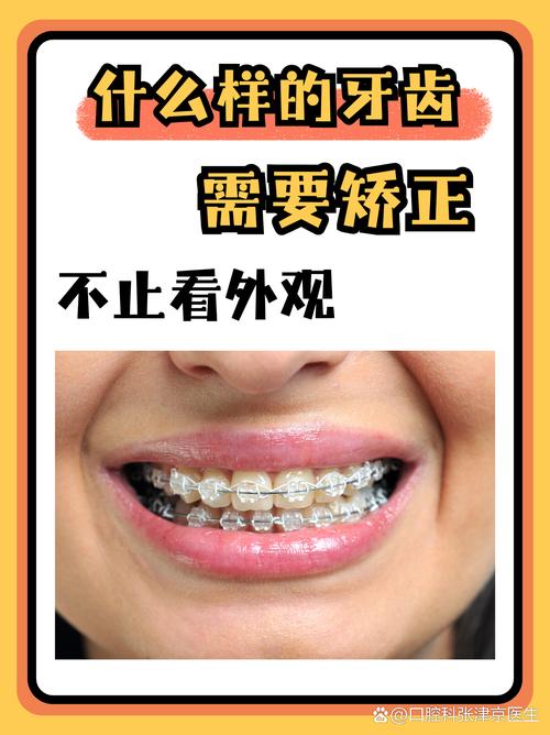 杭州45岁矫正牙齿还来得及吗？过来人分享3年真实经历，成人正畸必看