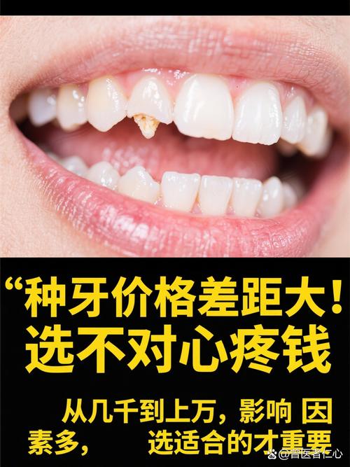 杭州种植牙再等5年爆发？价格已降，技术更微创，缺牙患者有福了