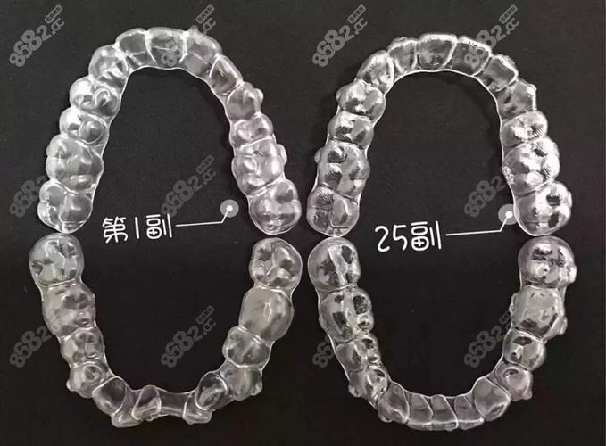 杭州深圳隐适美矫正费用全公开 花多少钱心里有数