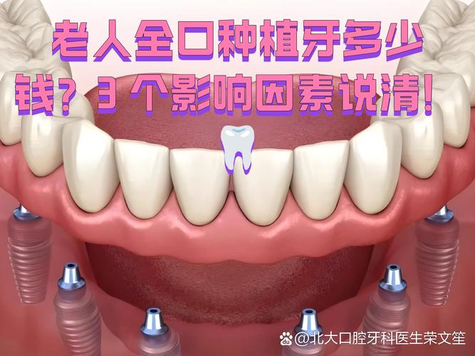 杭州深圳老人全口种牙费用明细 深圳全口种植牙价格参考