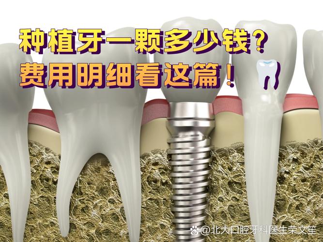 杭州西安种牙2026年最新报价：单颗2600到4900元真实情况揭秘