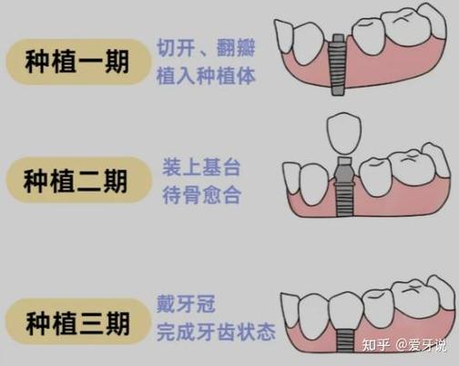 杭州种植牙骨粉贵不贵？要补多少？