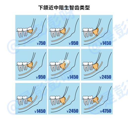 杭州口腔医院拔牙要花多少钱？怎么选才不踩坑？