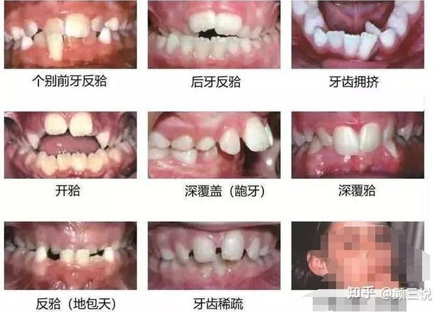杭州青岛儿童几岁做正畸最好？多少钱？