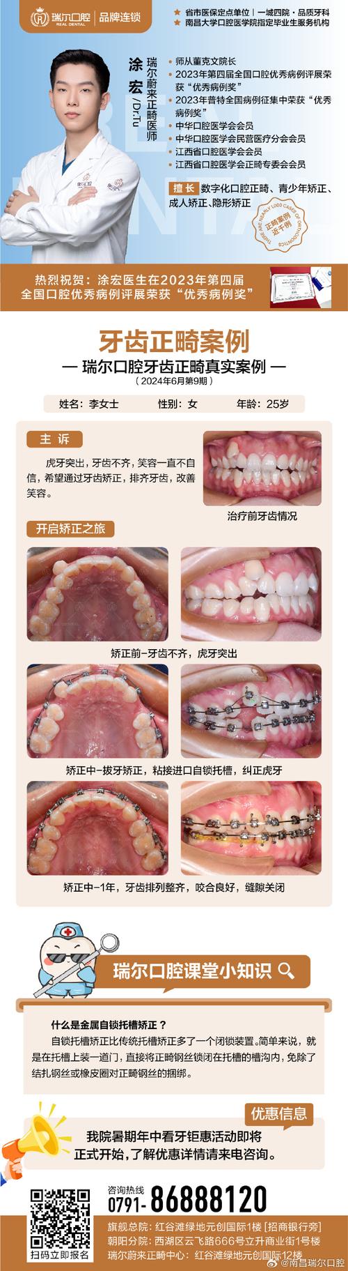 杭州成人龅牙矫正选医院还是诊所？关键看医生资质和案例对比