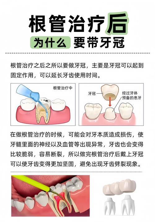 杭州根管治疗补牙到底怎么回事？医生详解步骤和必要性
