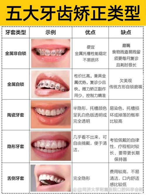杭州24岁想矫正牙齿晚么？现在开始刚刚好，成年人正畸全解答