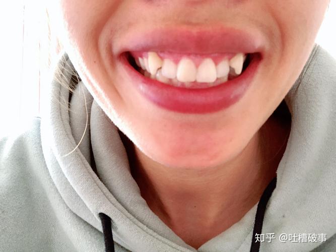 杭州虎牙想要快速矫正？攻略这里给你讲明白