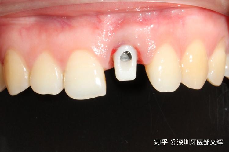 杭州大牙坏了还能马上种吗？牙医揭秘即拔即种的真相与风险