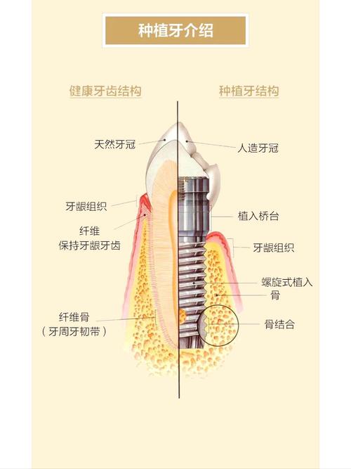 杭州什么叫种植牙齿 一篇讲清原理过程