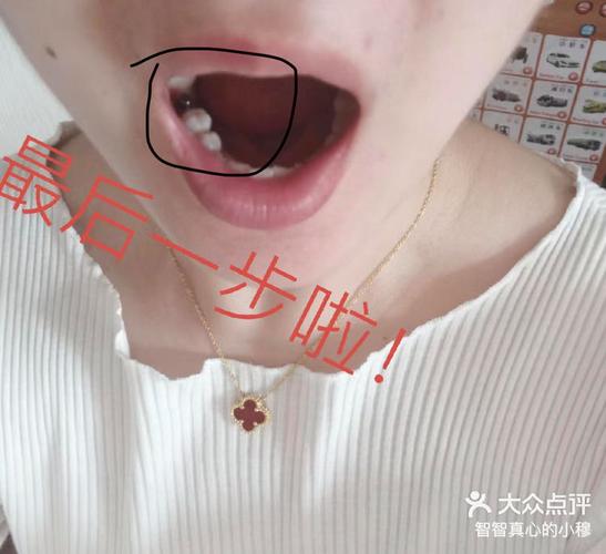 杭州宝安新安种植牙哪家医院好？真实体验告诉你