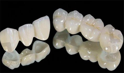 杭州深圳全瓷牙哪家牙科好 真实经验分享