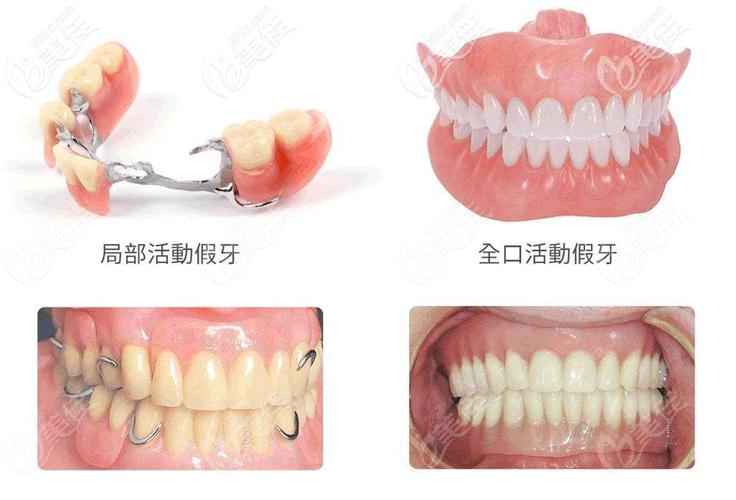 杭州洛阳种牙多少钱？2026年2500-4700元到底靠不靠谱