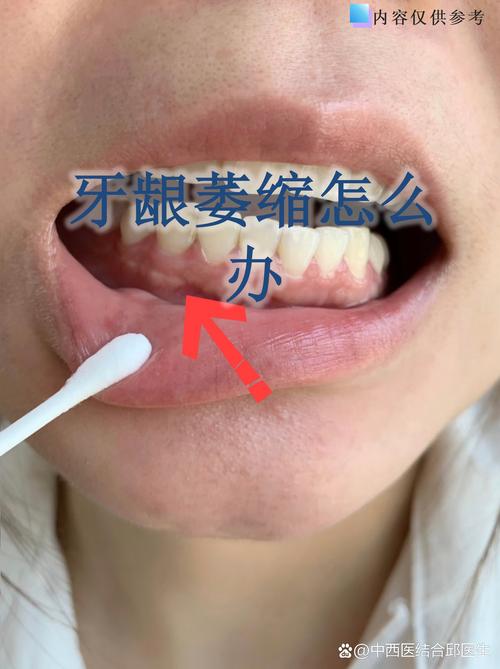 杭州缺牙不补的严重后果：邻牙倾斜松动，对牙伸长，牙槽骨萎缩
