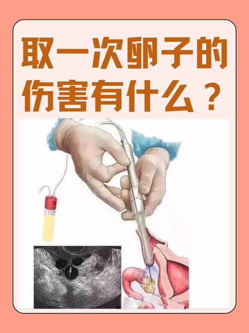 杭州取卵麻醉到底疼不疼 会不会影响卵子质量 医生一次说清