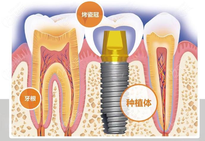 杭州赤峰种牙费用详解：从预算到效果，给您的实惠指南