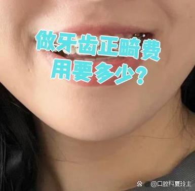 杭州深圳福田青少年钢丝矫正牙齿要花多少钱