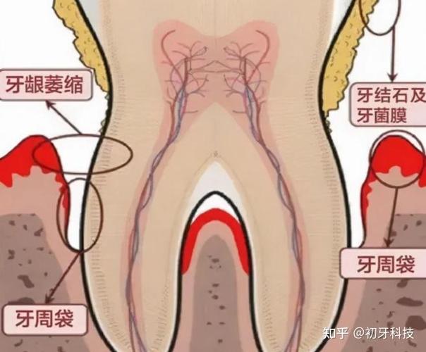 杭州贵阳种植牙2026年单颗3500到5500元贵吗
