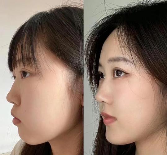 杭州14岁龅牙矫正多少钱？价格影响因素全解析