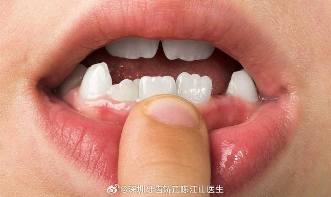 杭州小孩牙齿长成锯齿状，到底严重不严重？