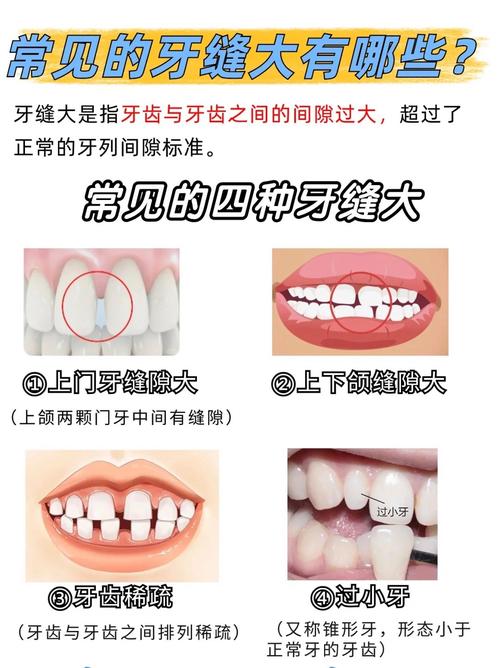 杭州矫正牙齿门牙缝隙变大了？医生告诉你正常吗咋应对