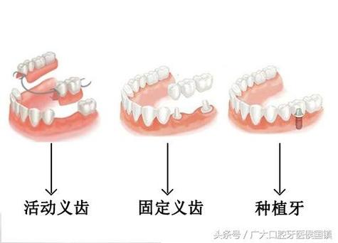 杭州北京种牙失败修复多少钱？游离体取出需花费多少？