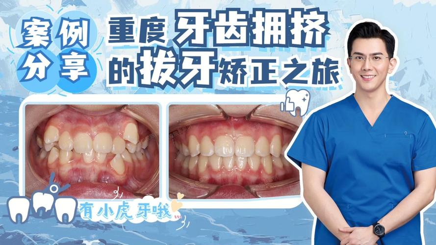 杭州告别“虎牙”尴尬，快速矫正重塑自信笑容