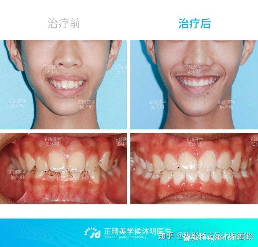 杭州25岁龅牙还能矫正吗？过来人分享真实经历