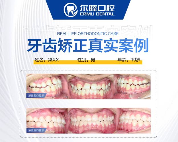 杭州深圳做MRC肌功能矫正到底要花多少钱？